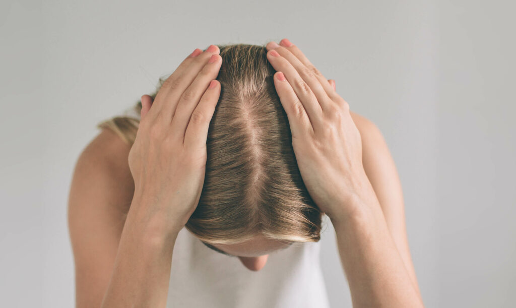 A woman shows her widening part due to androgenetic alopecia