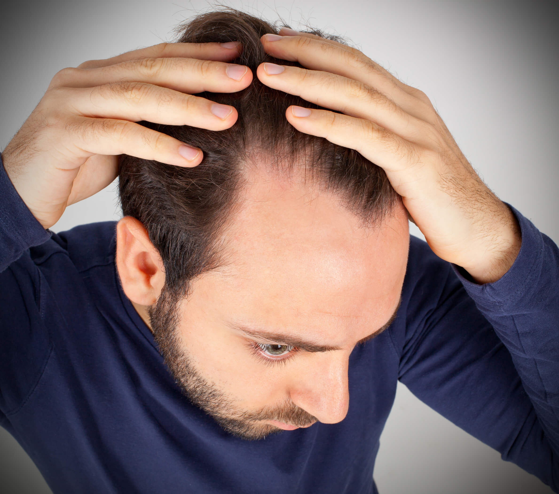 man with androgenetic alopecia hair loss