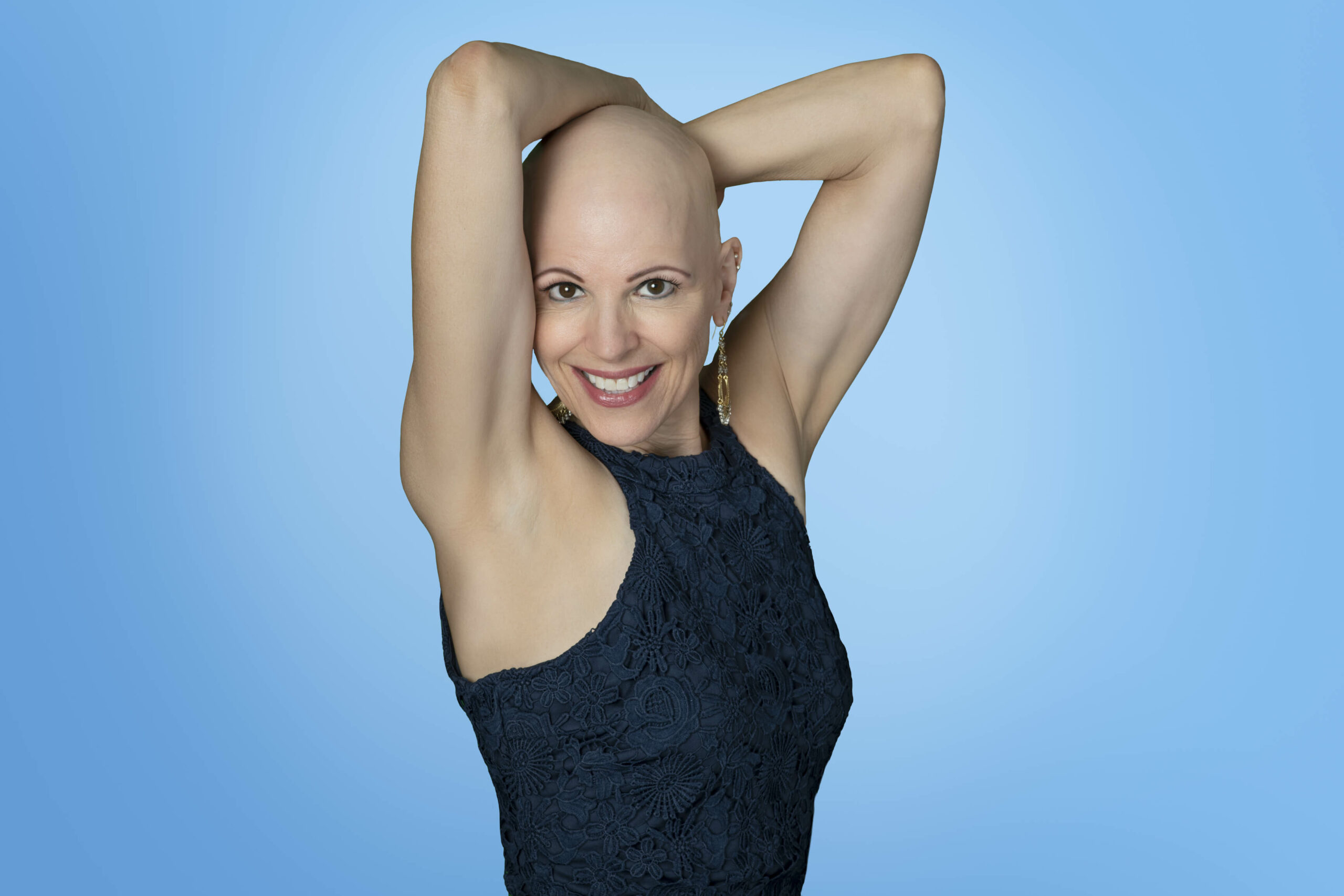 Confident woman with alopecia hair loss