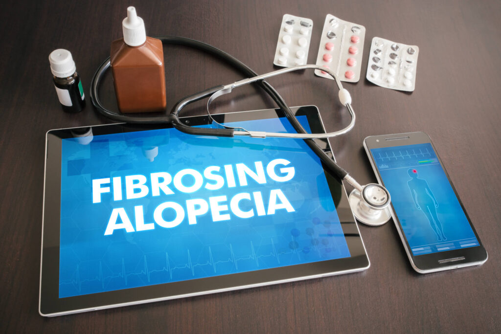 Frontal Fibrosing Alopecia is a specific type of hair loss